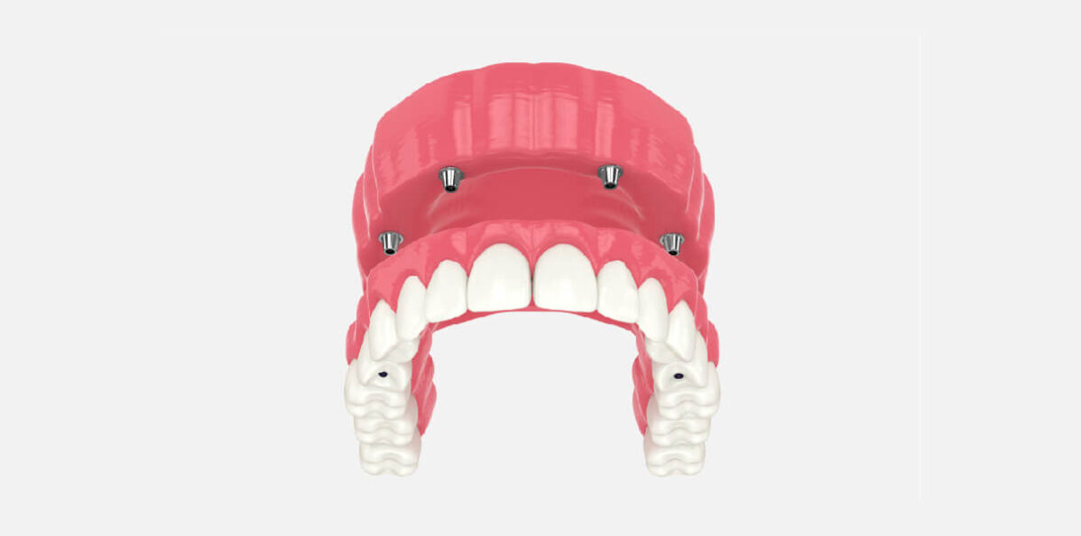 What are All-on-4 Implants, Their Procedure, Cost & Advantages