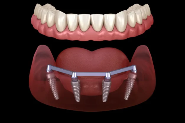 All-on-4 Dental Implants
