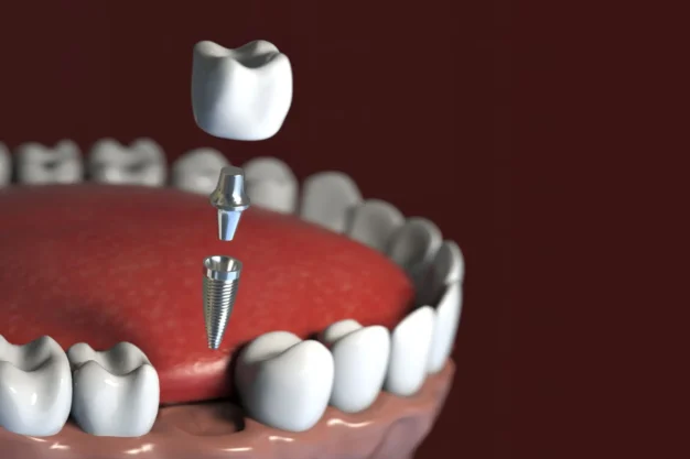 Dental Implants