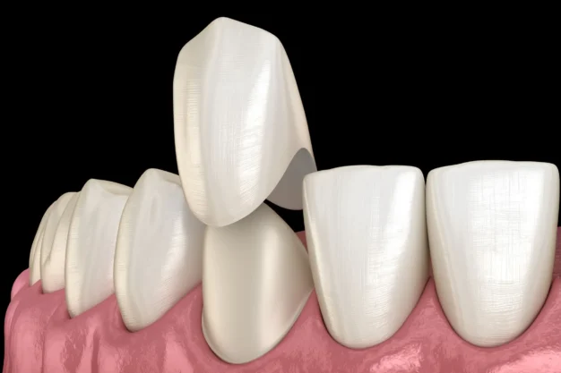 Dental Veneers