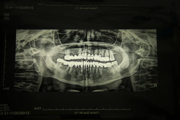 Digital Dental X-Rays