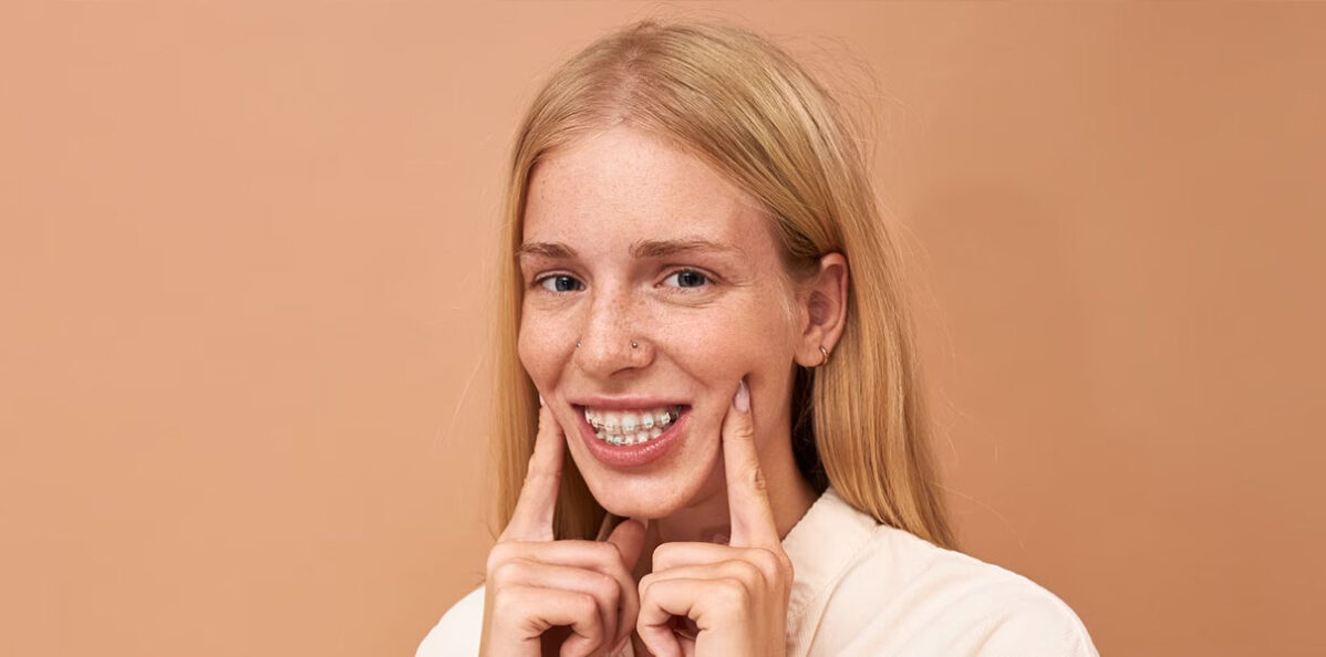 Why You Need Retainers after Braces