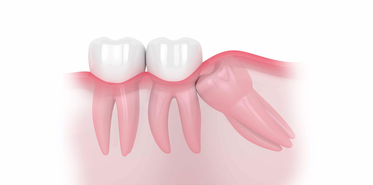 Wisdom Teeth Removal: Top Tips for a Speedy Recovery