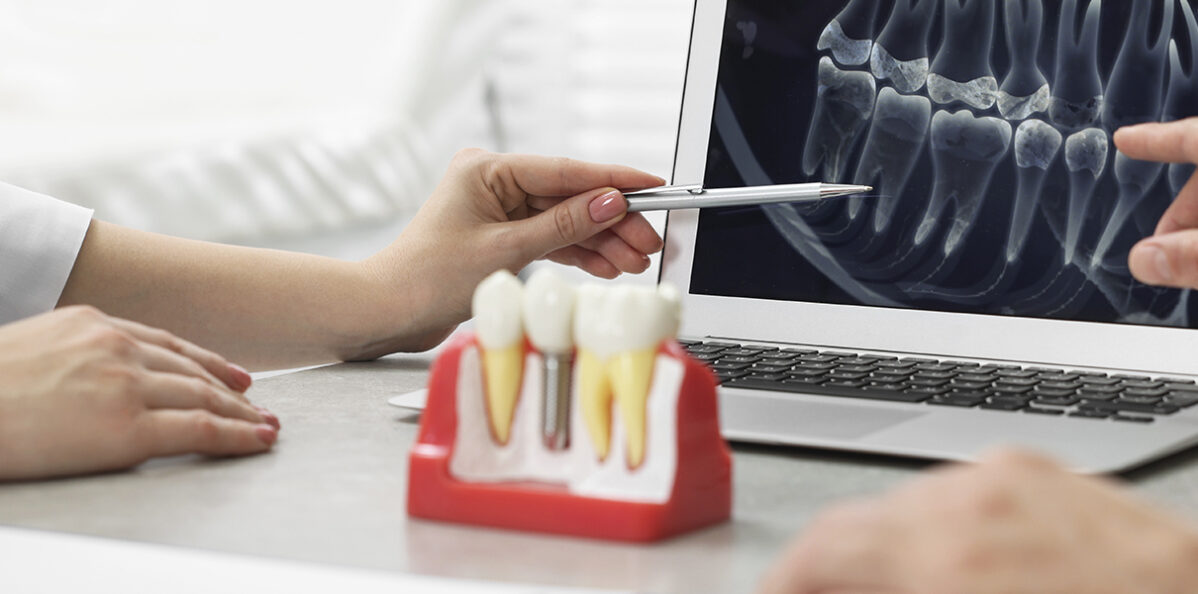 The Dental Implant Process: What to Expect from Beginning to End | Dentist 77584
