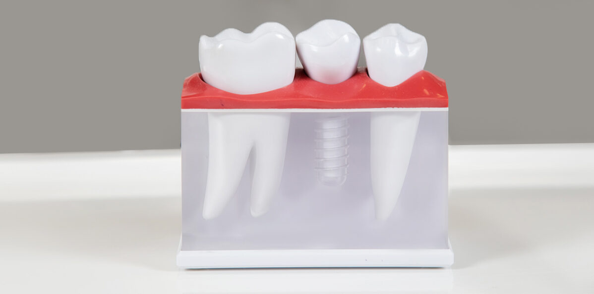 The Dental Implant Procedure: Step-by-Step | Dentist 77584