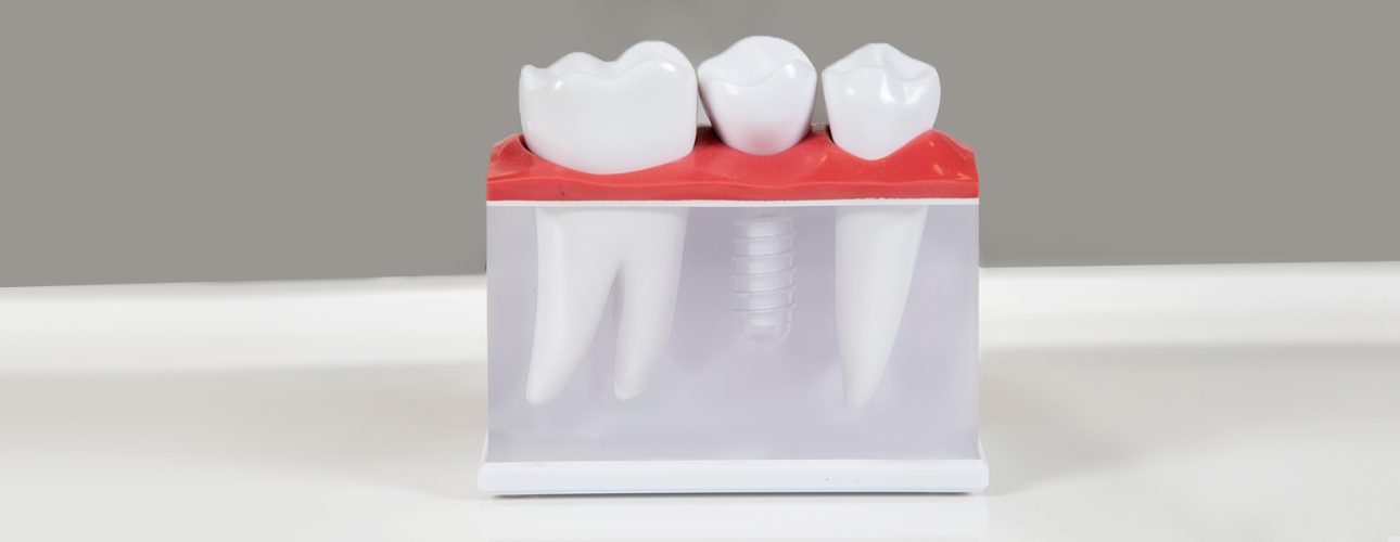 Dental Implant Procedure Dentist Pearland TX