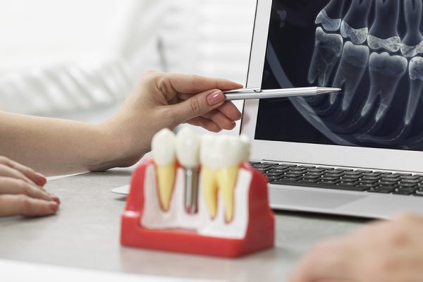 The Dental Implant Process Dentist Pearland TX