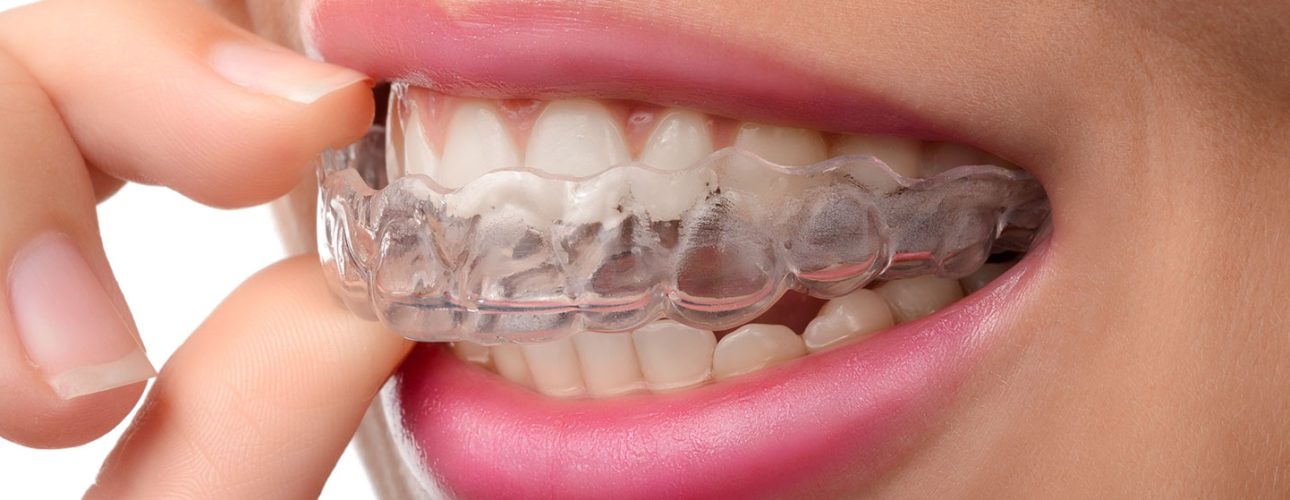 Invisalign