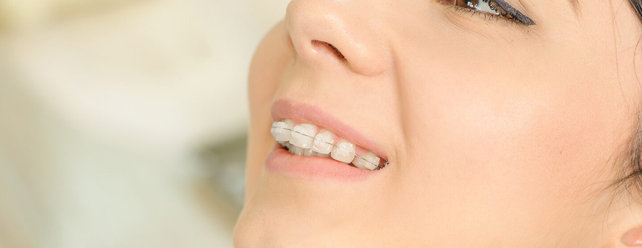 A lady with braces